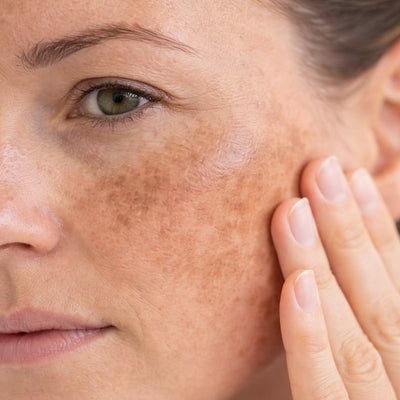 Melasma