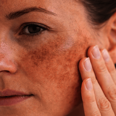 Melasma