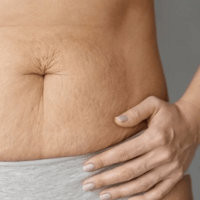 Anti Stretch Mark