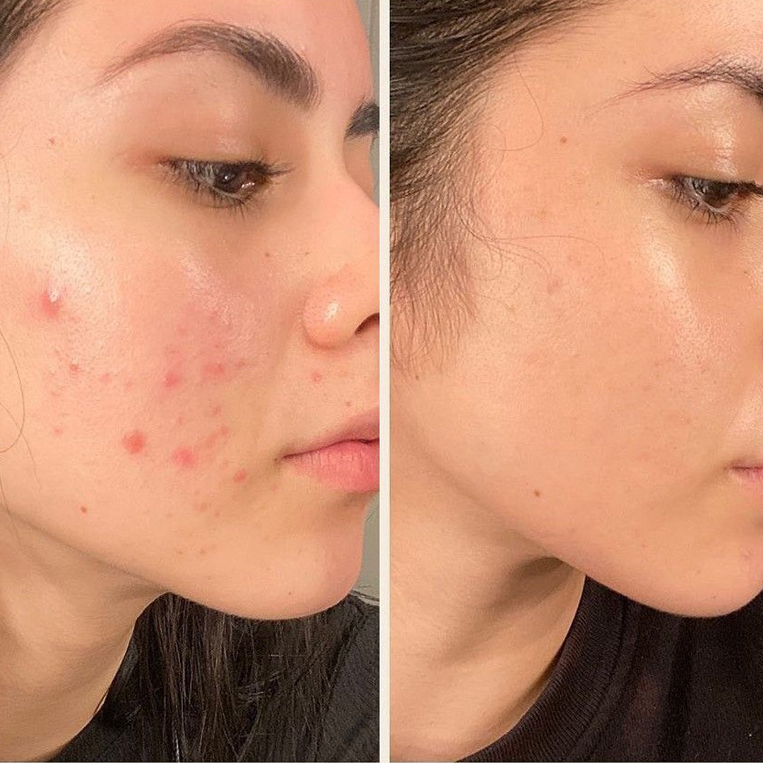 Before and after skincare result