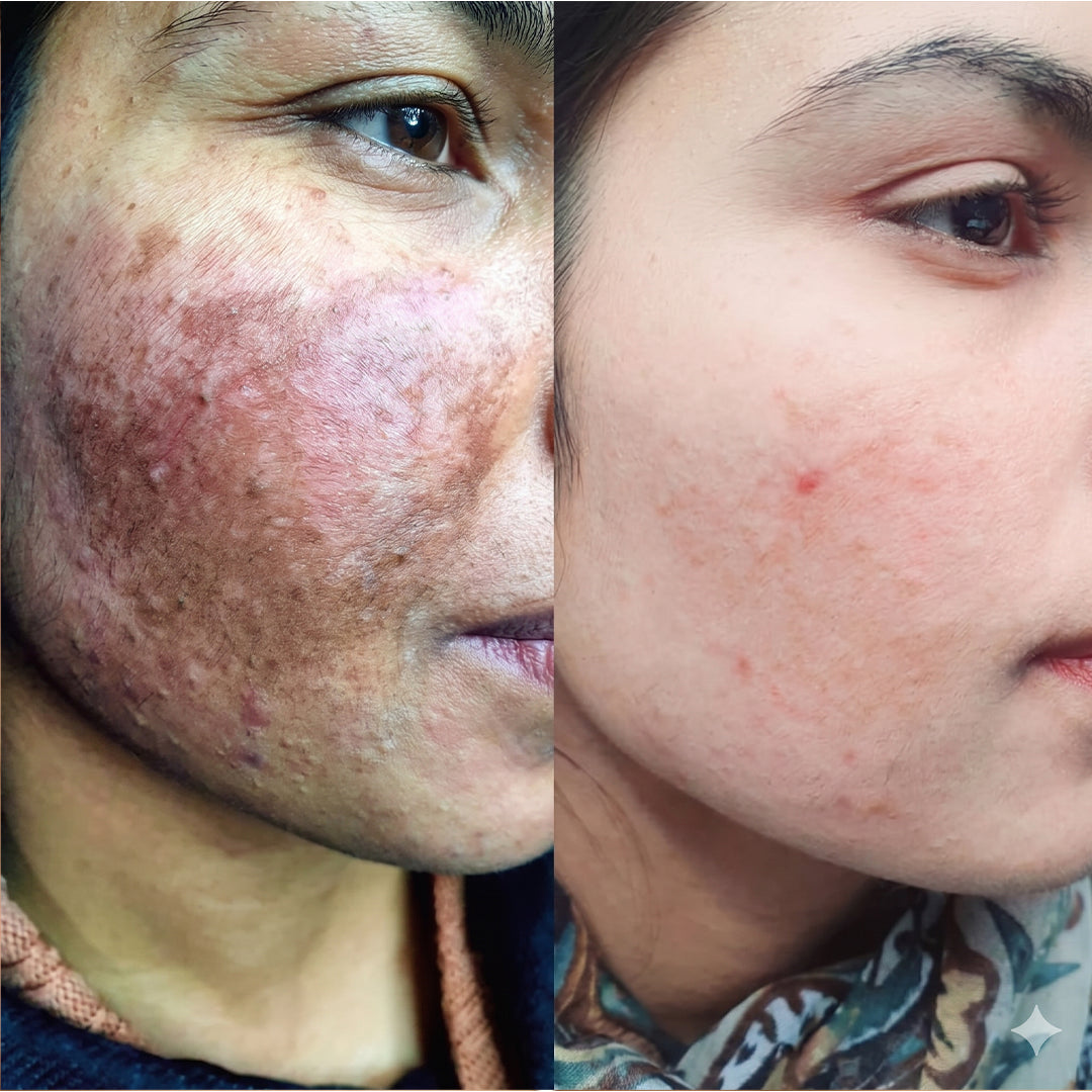Before and after skincare result