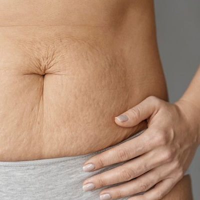 Anti Stretch Mark
